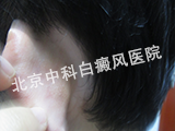 儿童白癜风怎么诊断