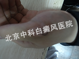 白癜风要如何治疗
