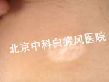 白癜风饮食要注意什么